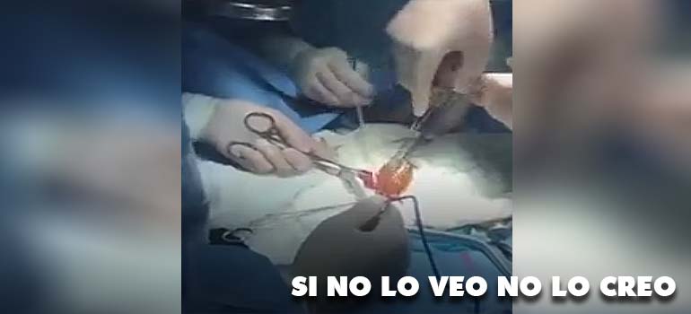 Extraños casos médicos: Operación para sacar un dildo de más de un metro. 11
